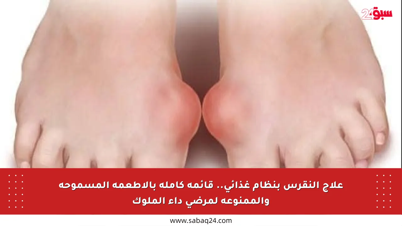 علاج النقرس بنظام غذائي.. قائمة كاملة بالأطعمة المسموحة والممنوعة لمرضى داء الملوك